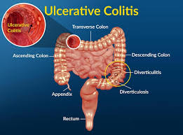 Ulcerative Colitis Treatment in Electronic City